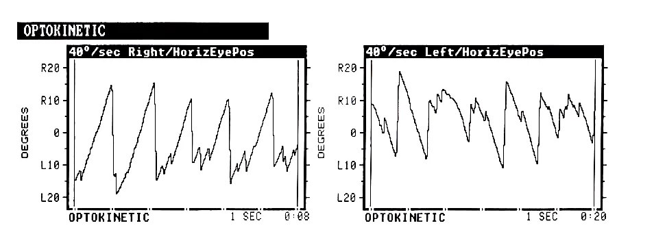 博闻 | VNG眼震视图检查（四）视动试验(图8)