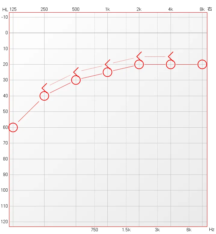 博闻 | 熬夜后耳鸣、听不清?警惕突发性耳聋!(图10) 博闻 | 熬夜后耳鸣、听不清?警惕突发性耳聋!(图10)