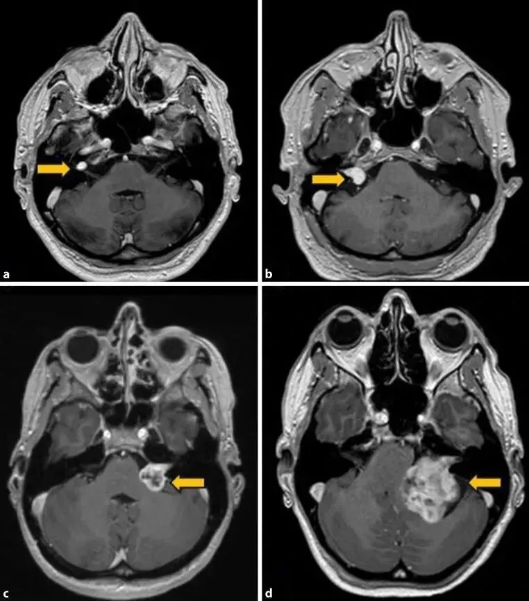博闻 | 熬夜后耳鸣、听不清?警惕突发性耳聋!(图16) 博闻 | 熬夜后耳鸣、听不清?警惕突发性耳聋!(图16)