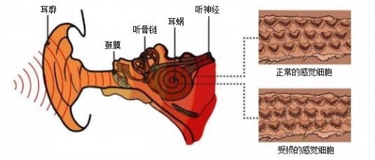 博闻 | 熬夜后耳鸣、听不清?警惕突发性耳聋!(图9) 博闻 | 熬夜后耳鸣、听不清?警惕突发性耳聋!(图9)